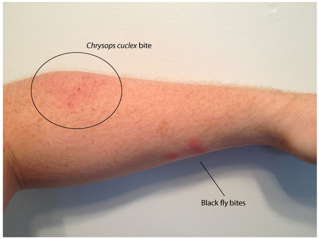 Chrysops cuclux bite after 18hrs